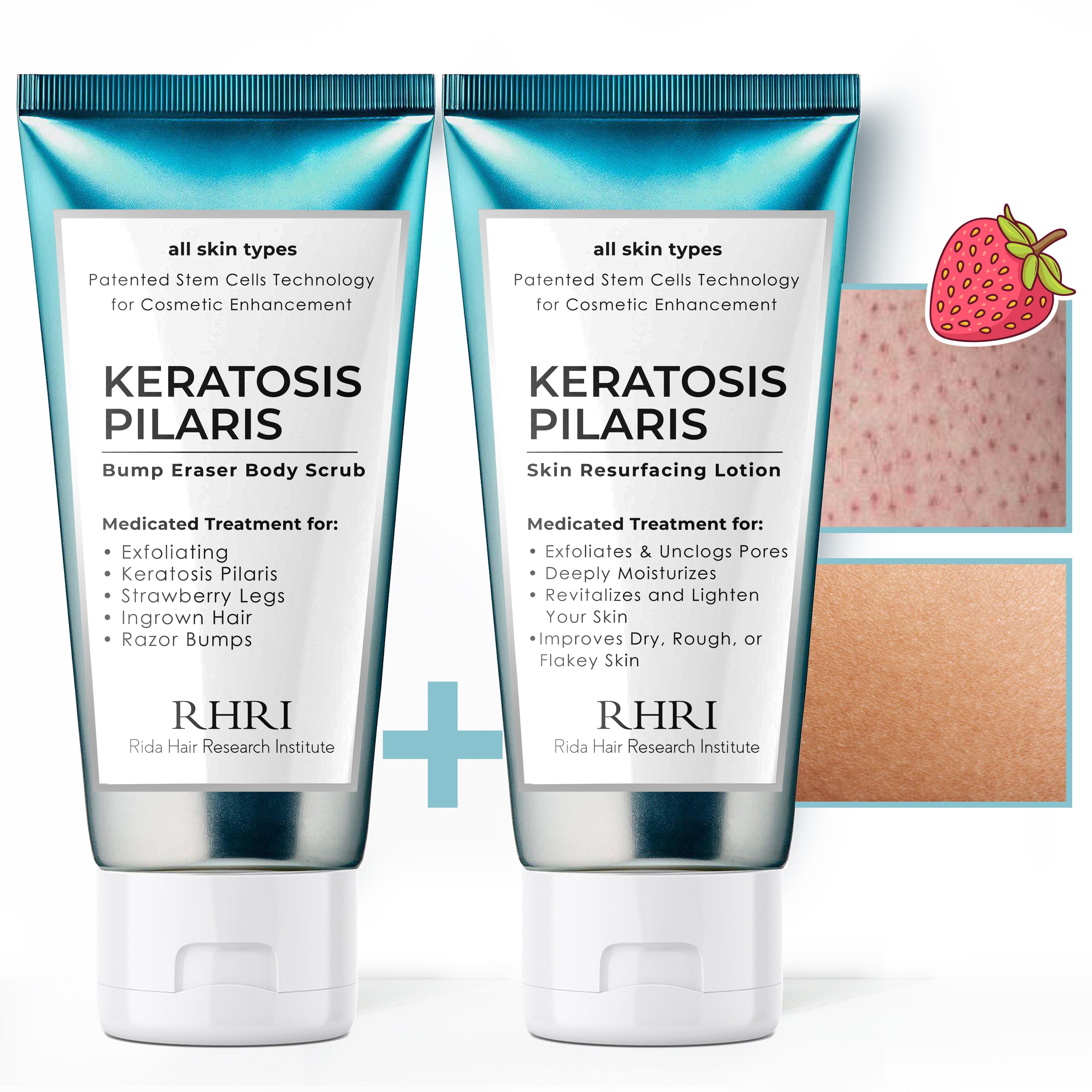 Keratosis Pilaris Bump Eraser Body Scrub + Lotion Set