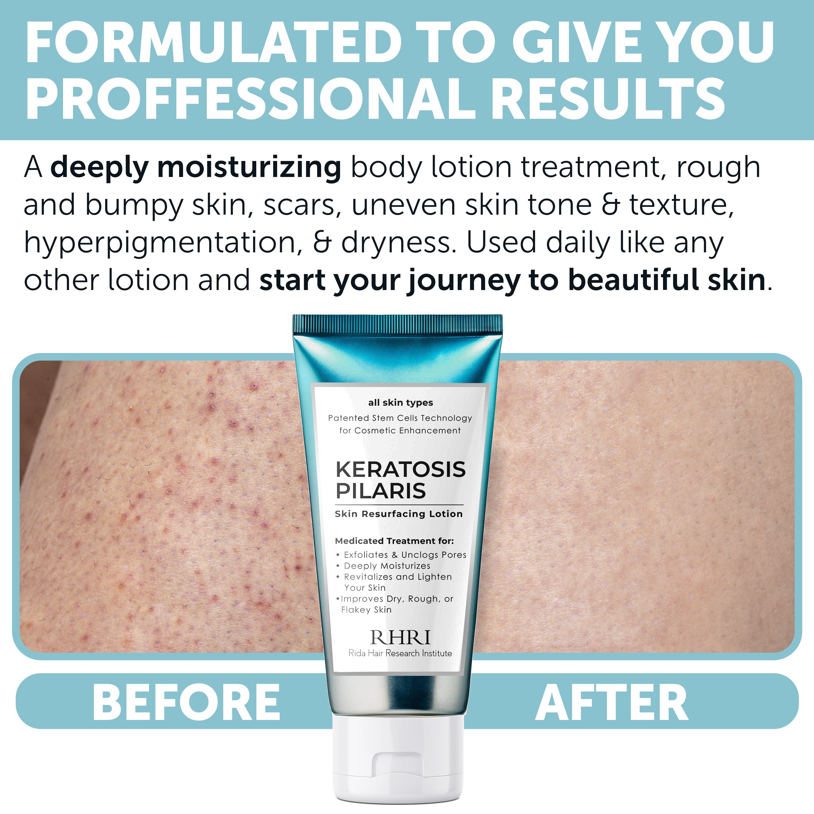 Keratosis Pilaris Lotion