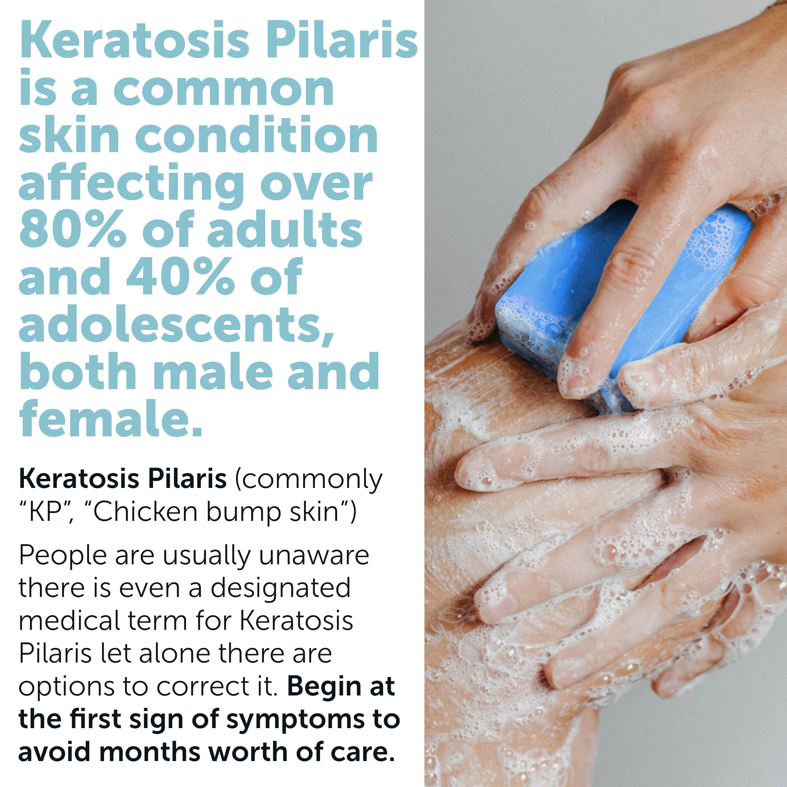 Body Soap Scrub with 10% AHA & Micro Pumice Beads for Keratosis Pilaris 4.2 oz (860012882199)