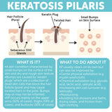 Body Soap Scrub with 10% AHA & Micro Pumice Beads for Keratosis Pilaris 4.2 oz (860012882199)