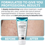 Keratosis Pilaris Lotion