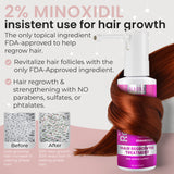 Remixidil Women's 2% Minoxidil Scalp Spray