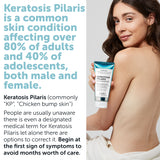 Keratosis Pilaris Lotion